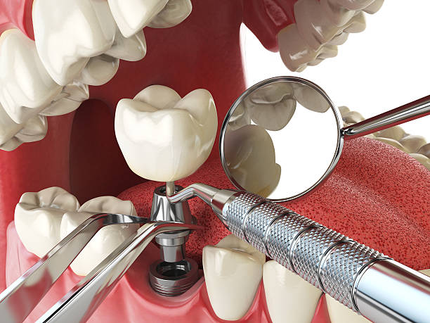 Best Emergency Dentist for Lost Fillings or Crowns in Chubbuck, ID